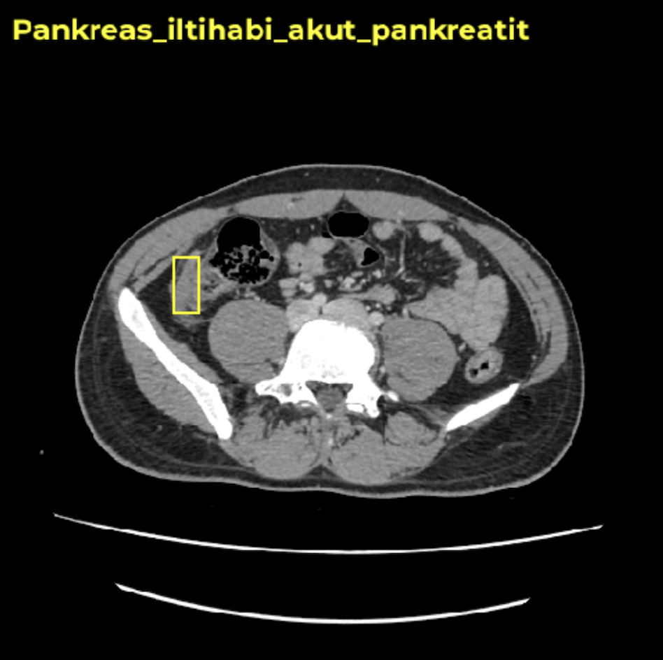 abdominal disease detection